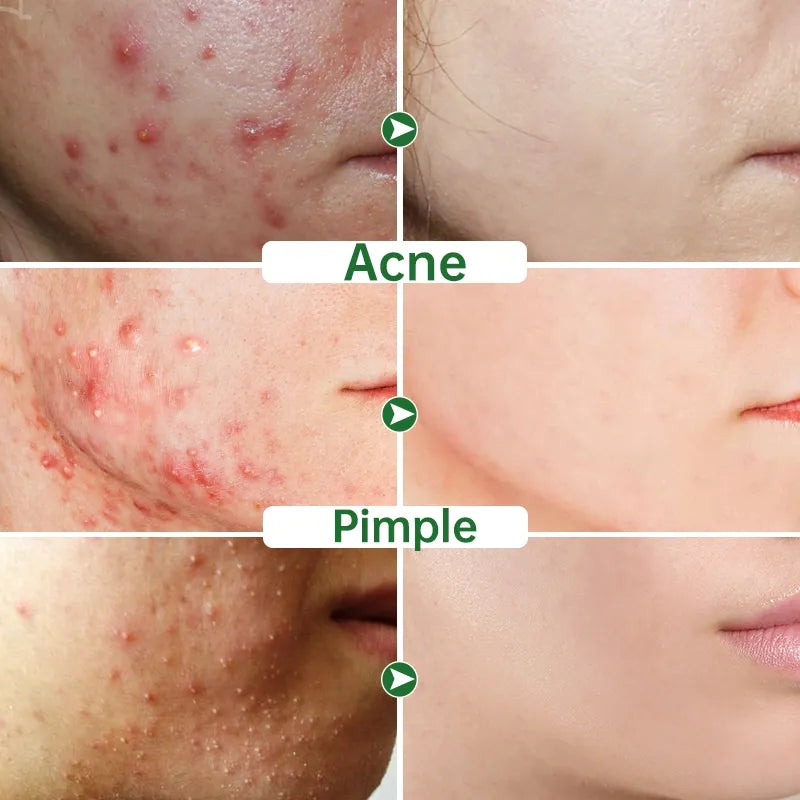 Lozione magica per la riparazione del viso/corpo per acne, brufoli, eczema, macchie scure/rosse, iperpigmentazione, eruzioni cutanee, ecc. Risultati garantiti in 5-7 giorni