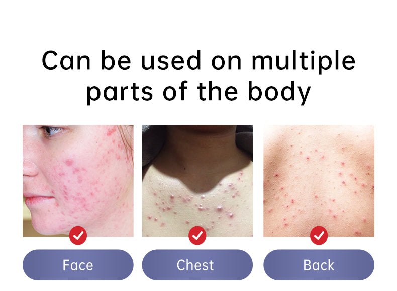 Lozione magica per la riparazione del viso/corpo per acne, brufoli, eczema, macchie scure/rosse, iperpigmentazione, eruzioni cutanee, ecc. Risultati garantiti in 5-7 giorni