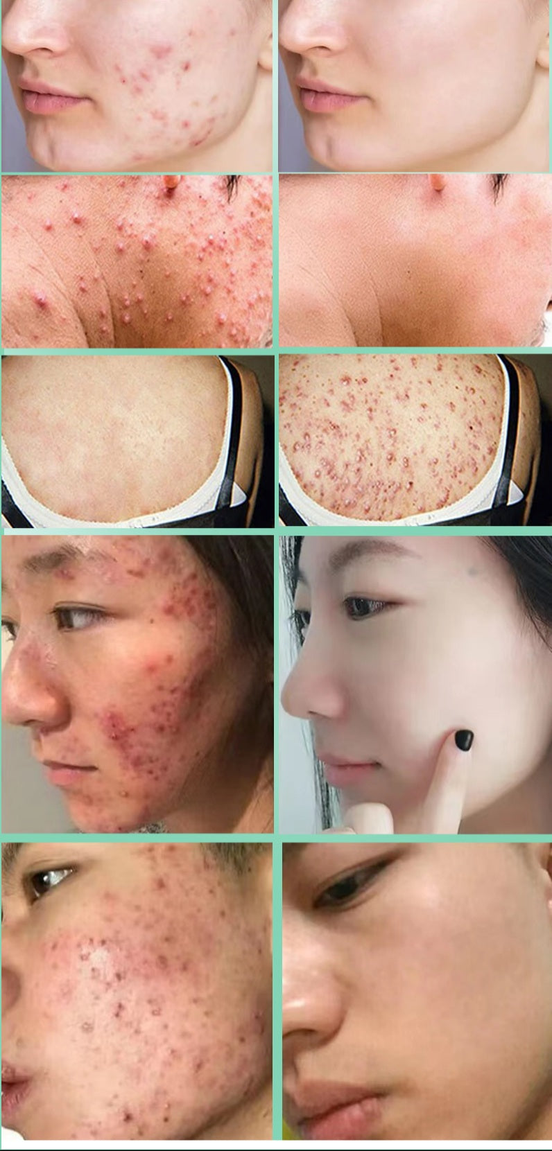 Lozione magica per la riparazione del viso/corpo per acne, brufoli, eczema, macchie scure/rosse, iperpigmentazione, eruzioni cutanee, ecc. Risultati garantiti in 5-7 giorni